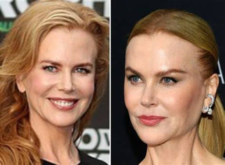 Did Nicole Kidman's Stunning Transformation Involve Plastic Surgery?