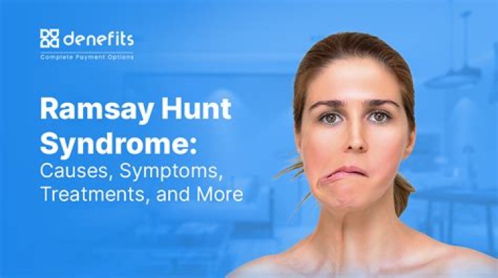 Discover The Hidden Truth About Ramsay Hunt Syndrome