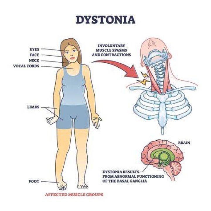 Does Kerry Kennedy Suffer From Spasmodic Dysphonia?