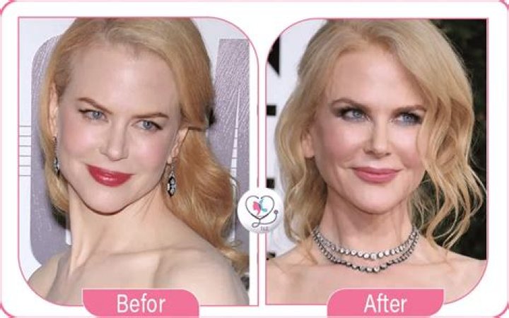 Expert Insights: Has Nicole Kidman Embraced Cosmetic Surgery Procedures?