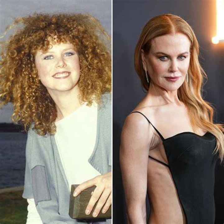 Nicole Kidman's Recent Plastic Surgery Transformation: Unveiling The Secrets
