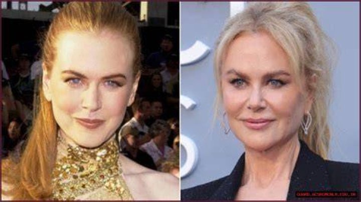 The Evolution Of Nicole Kidman's Appearance: A Look At Her Plastic Surgery Journey