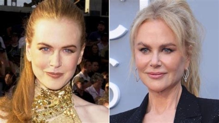 The Evolving Face Of Beauty: Nicole Kidman's Journey With Plastic Surgery