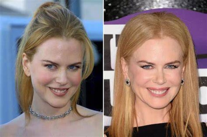 The Truth About Nicole Kidman's Alleged Plastic Surgery