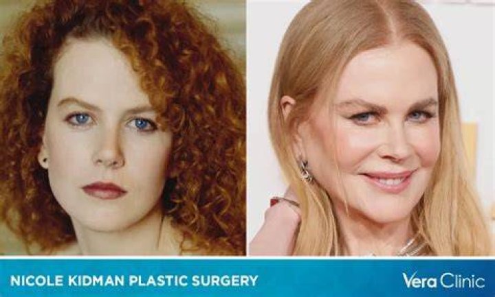 The Ultimate Guide To Nicole Kidman's Plastic Surgery Journey