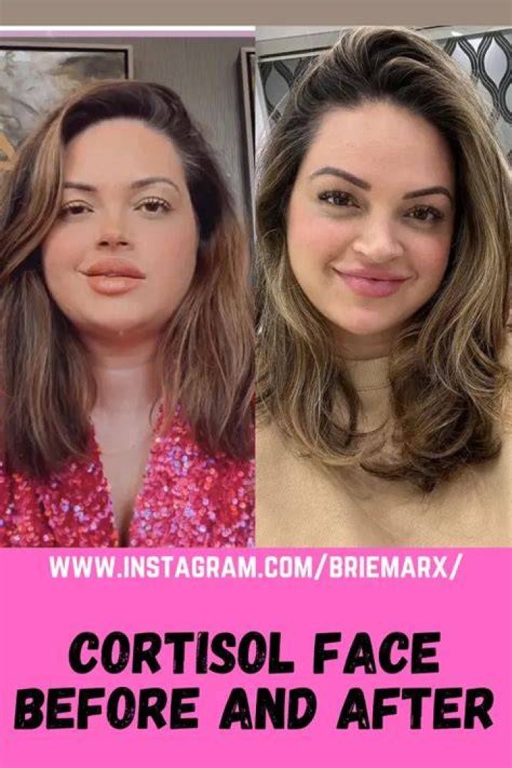 Transformations Of The Face: Before And After High Cortisol Levels
