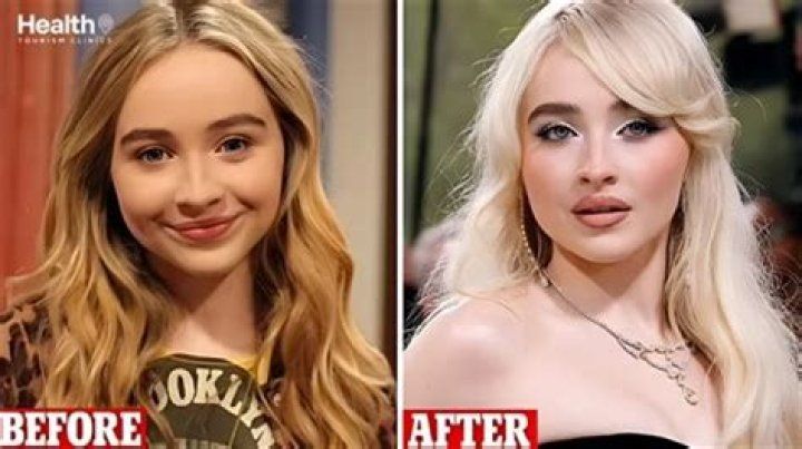 Uncovering The Truth: Has Sabrina Carpenter Undergone Surgery?